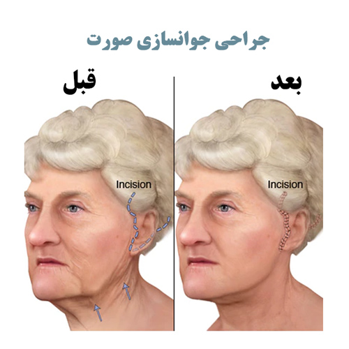 جراحی جوانسازی صورت