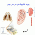 پیوند غضروف در جراحی بینی