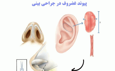 پیوند غضروف در جراحی بینی