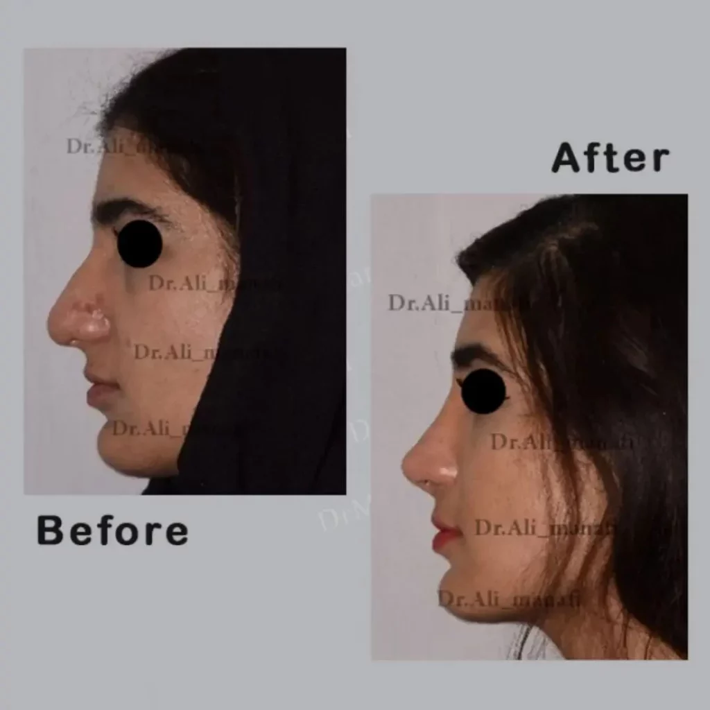 نمونه کار جراحی بینی 30