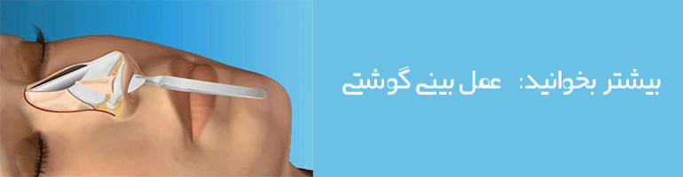 مراقبت های بعد از عمل بینی