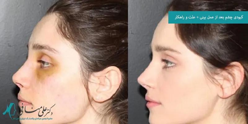 کبودی چشم بعد از عمل بینی + علت و راهکار