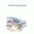 جراحی بینی به شیوه بسته