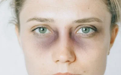 کبودی چشم بعد از عمل بینی + علت و راهکار