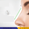 هزینه عمل زیبایی بینی استخوانی