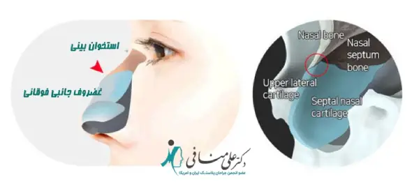 نقش کیستون در عمل قوز بینی
